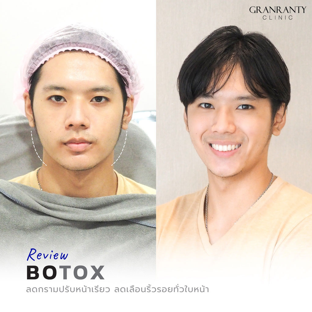 รีวิว BOTOX จีแรนตีคลินิก