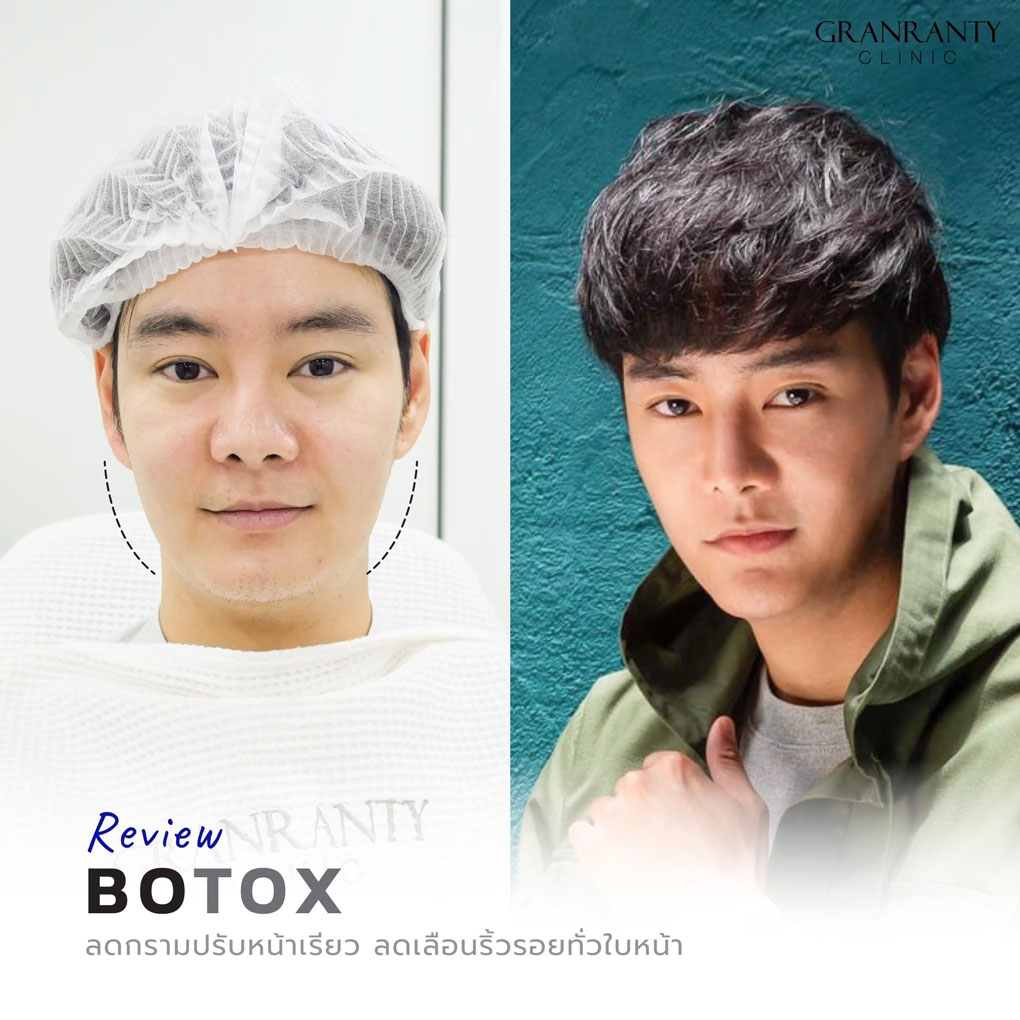 รีวิว BOTOX จีแรนตีคลินิก