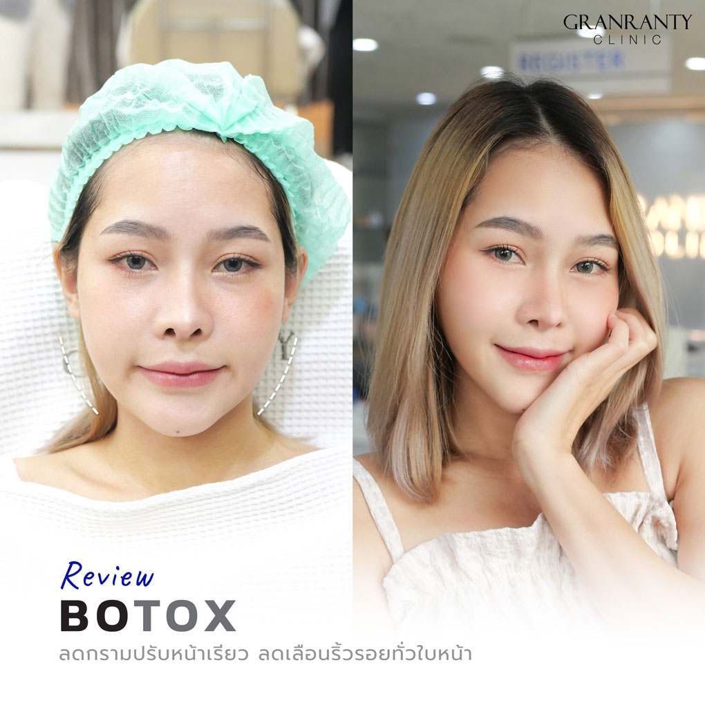 รีวิว BOTOX จีแรนตีคลินิก