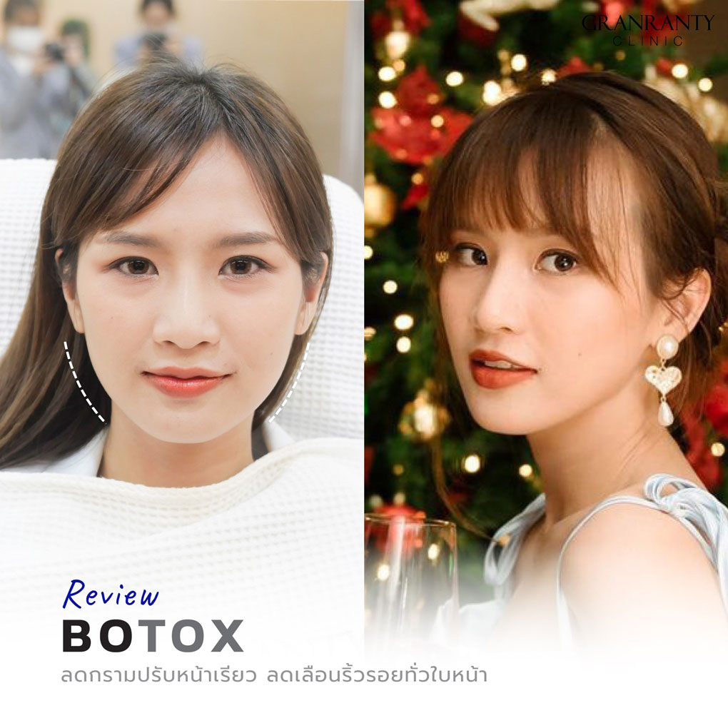 รีวิว BOTOX จีแรนตีคลินิก