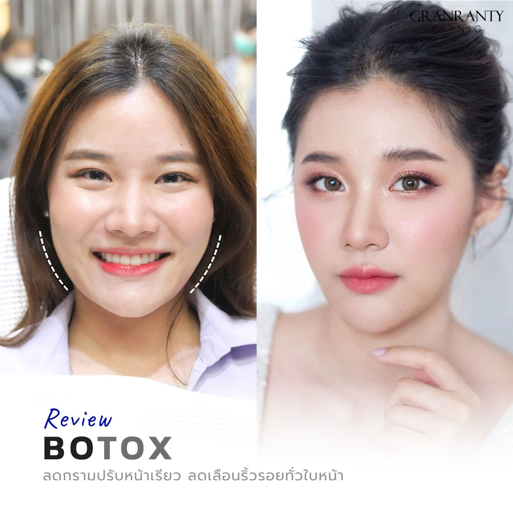 รีวิว BOTOX จีแรนตีคลินิก