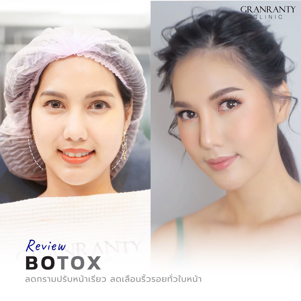 รีวิว BOTOX จีแรนตีคลินิก