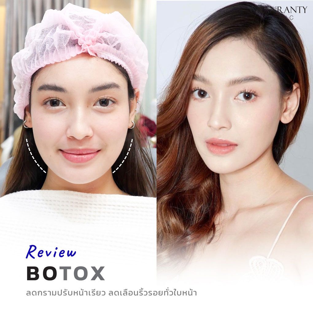 รีวิว BOTOX จีแรนตีคลินิก