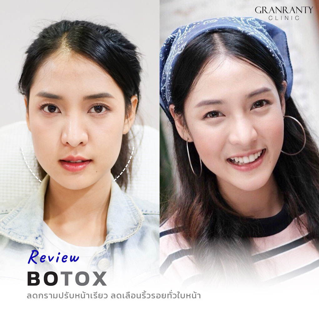 รีวิว BOTOX จีแรนตีคลินิก