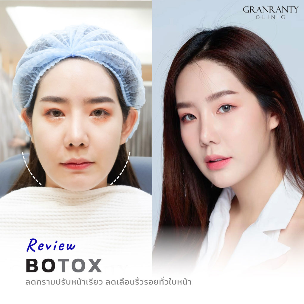 รีวิว BOTOX จีแรนตีคลินิก