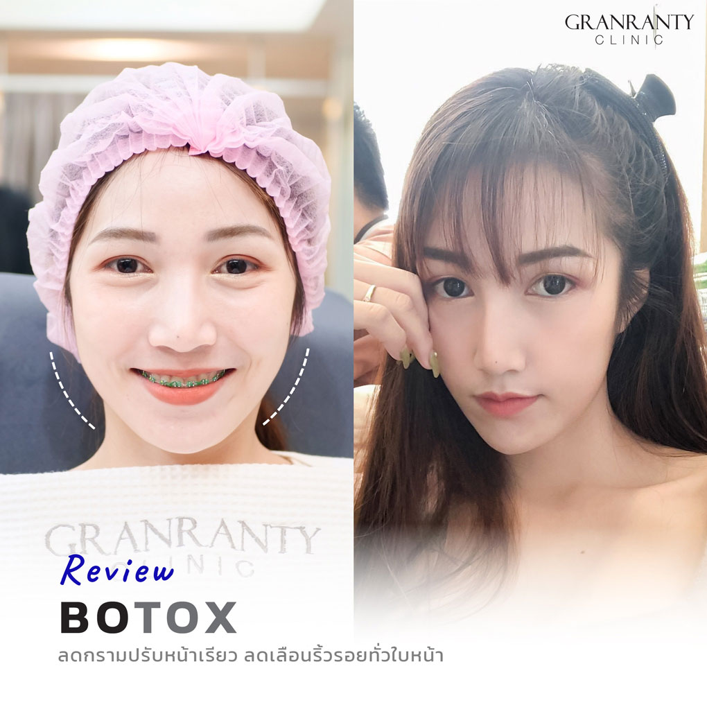 รีวิว BOTOX จีแรนตีคลินิก