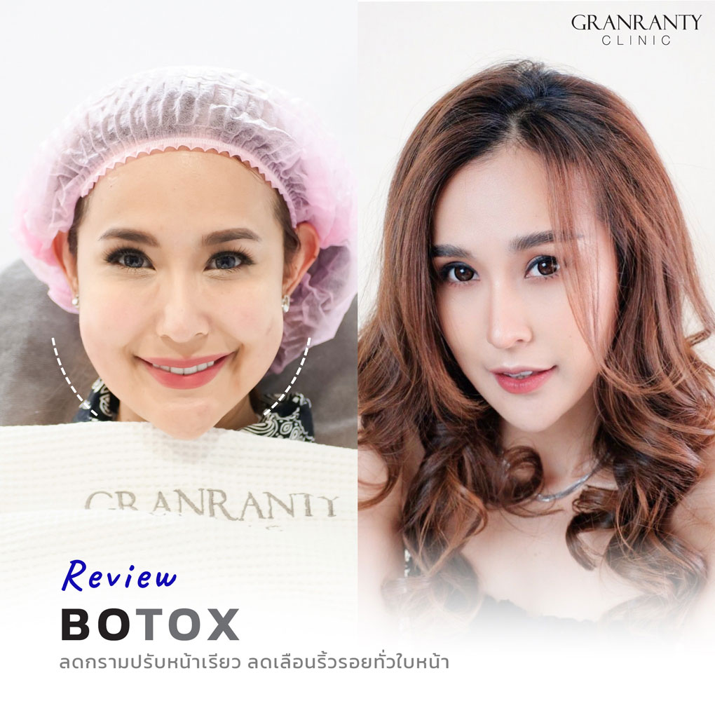 รีวิว BOTOX จีแรนตีคลินิก