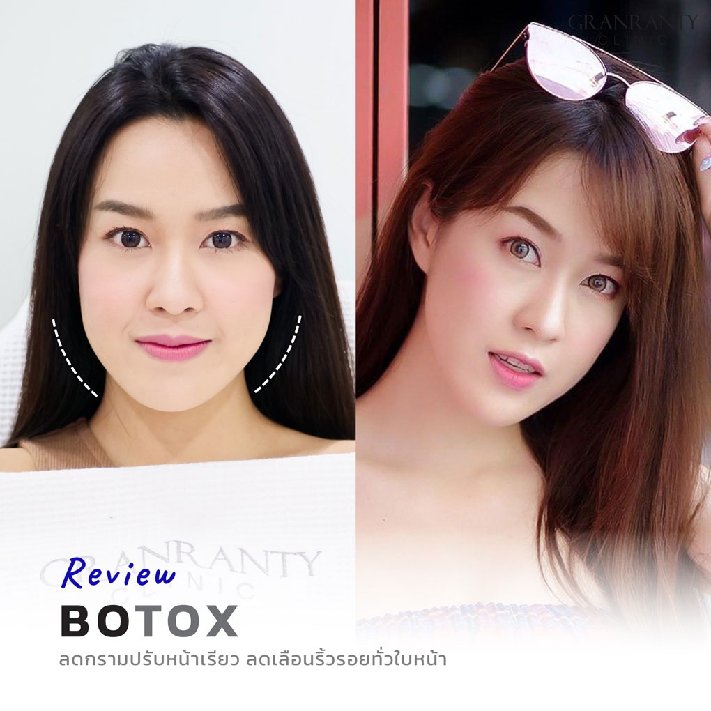 รีวิว BOTOX จีแรนตีคลินิก