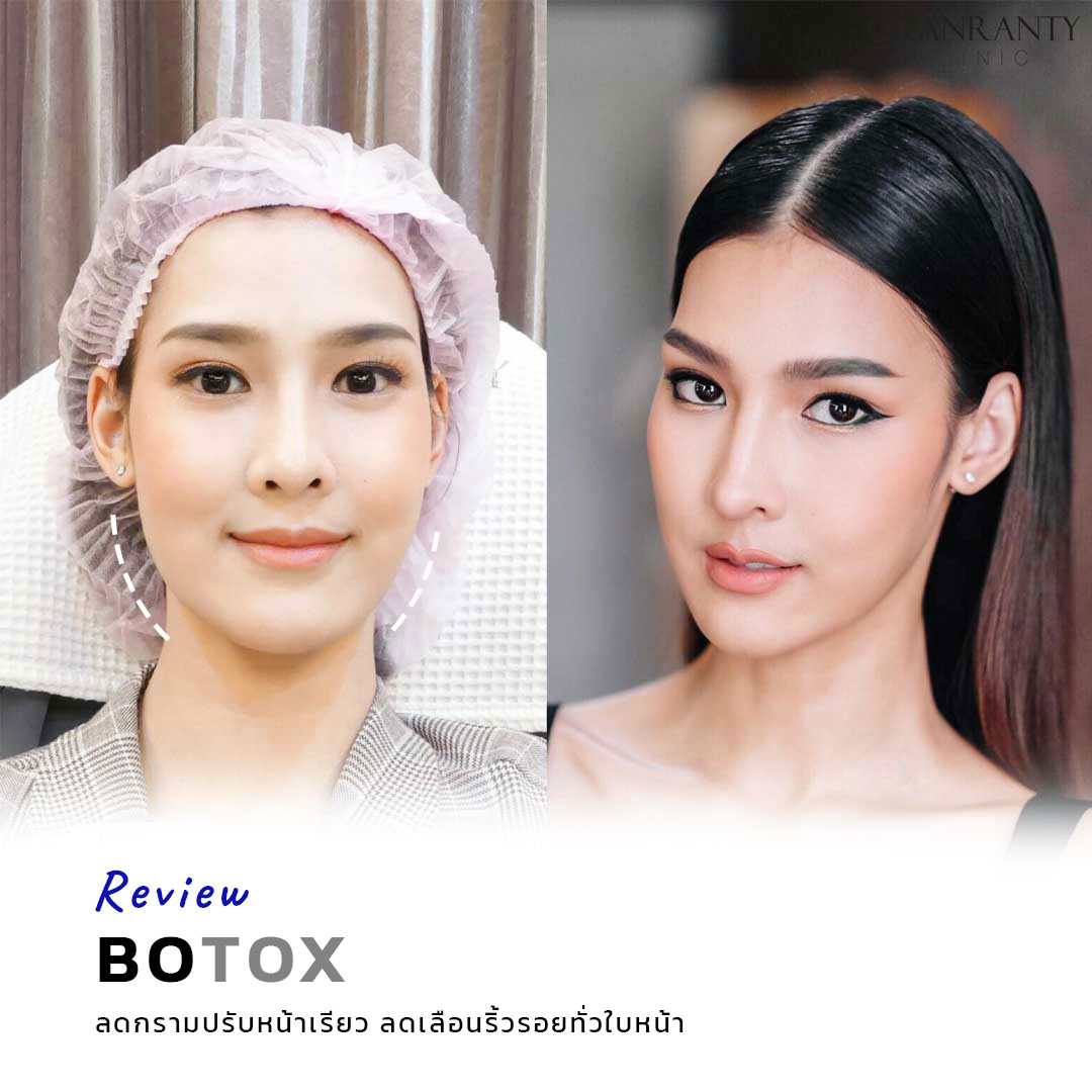 รีวิว BOTOX จีแรนตีคลินิก