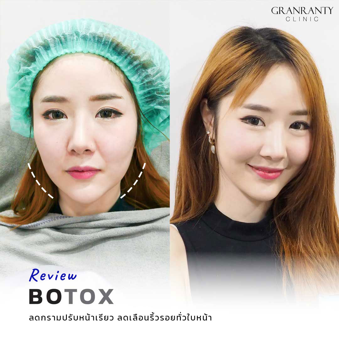 รีวิว BOTOX จีแรนตีคลินิก