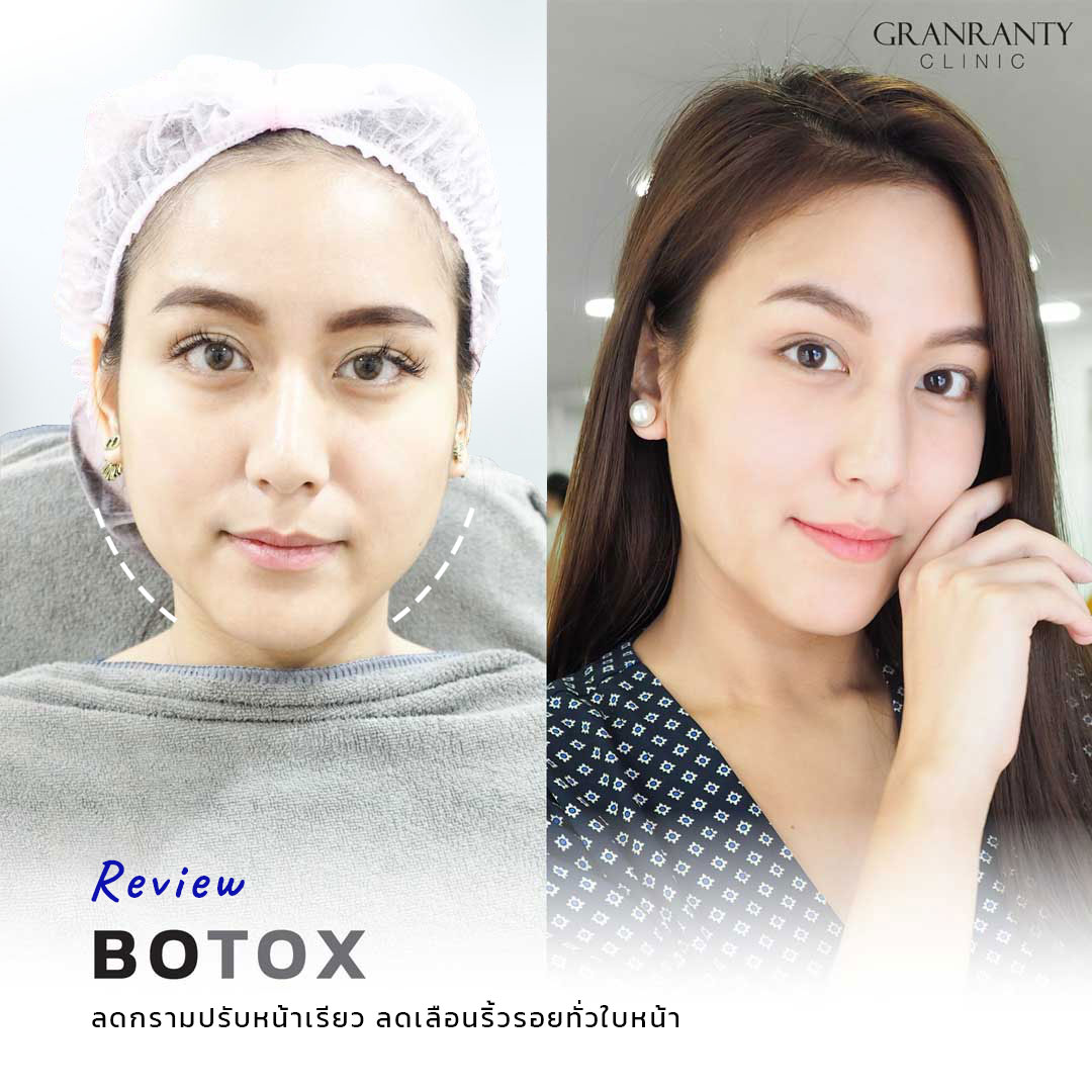 รีวิว BOTOX จีแรนตีคลินิก