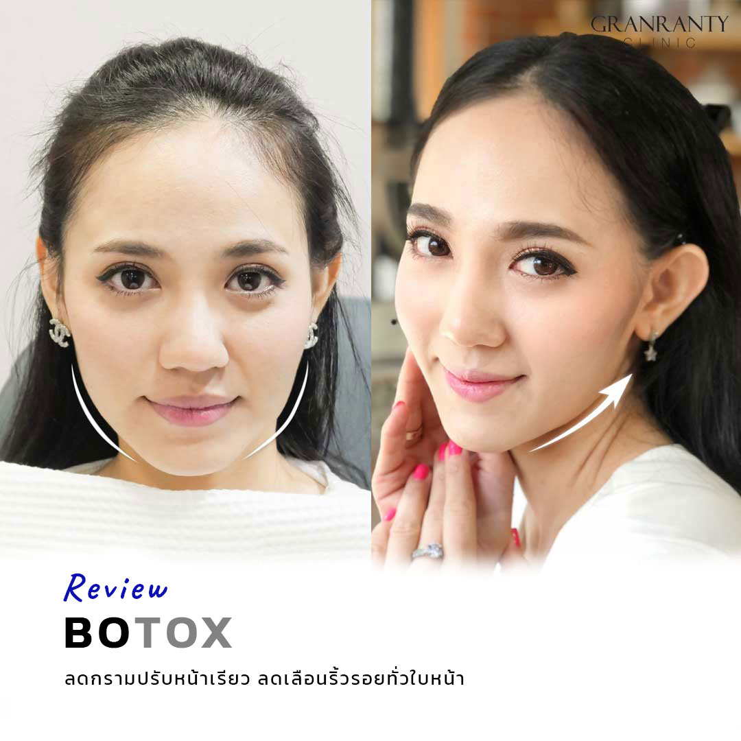 รีวิว BOTOX จีแรนตีคลินิก