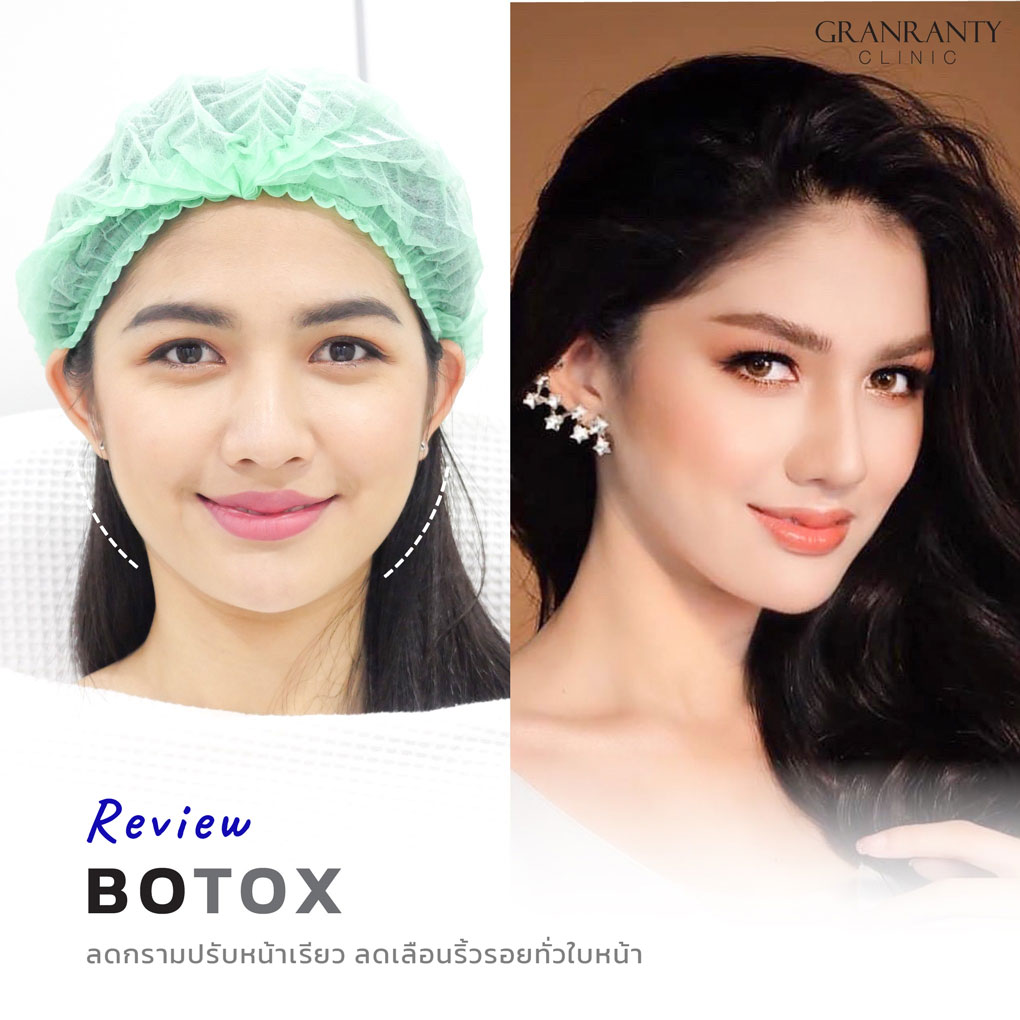 รีวิว BOTOX จีแรนตีคลินิก