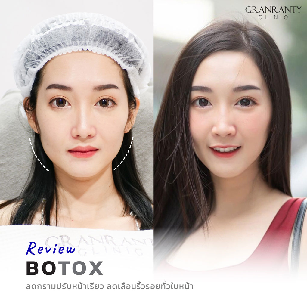 รีวิว BOTOX จีแรนตีคลินิก