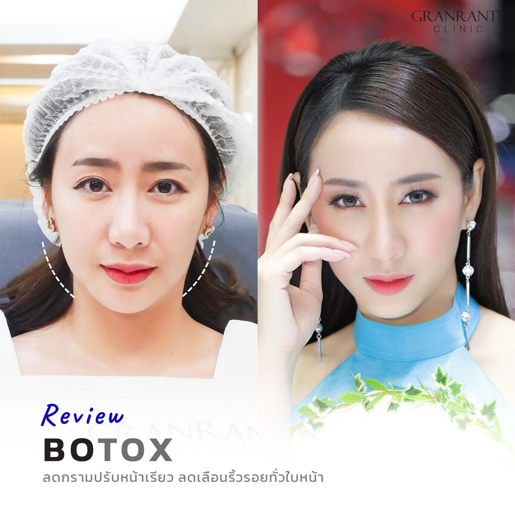 รีวิว BOTOX จีแรนตีคลินิก