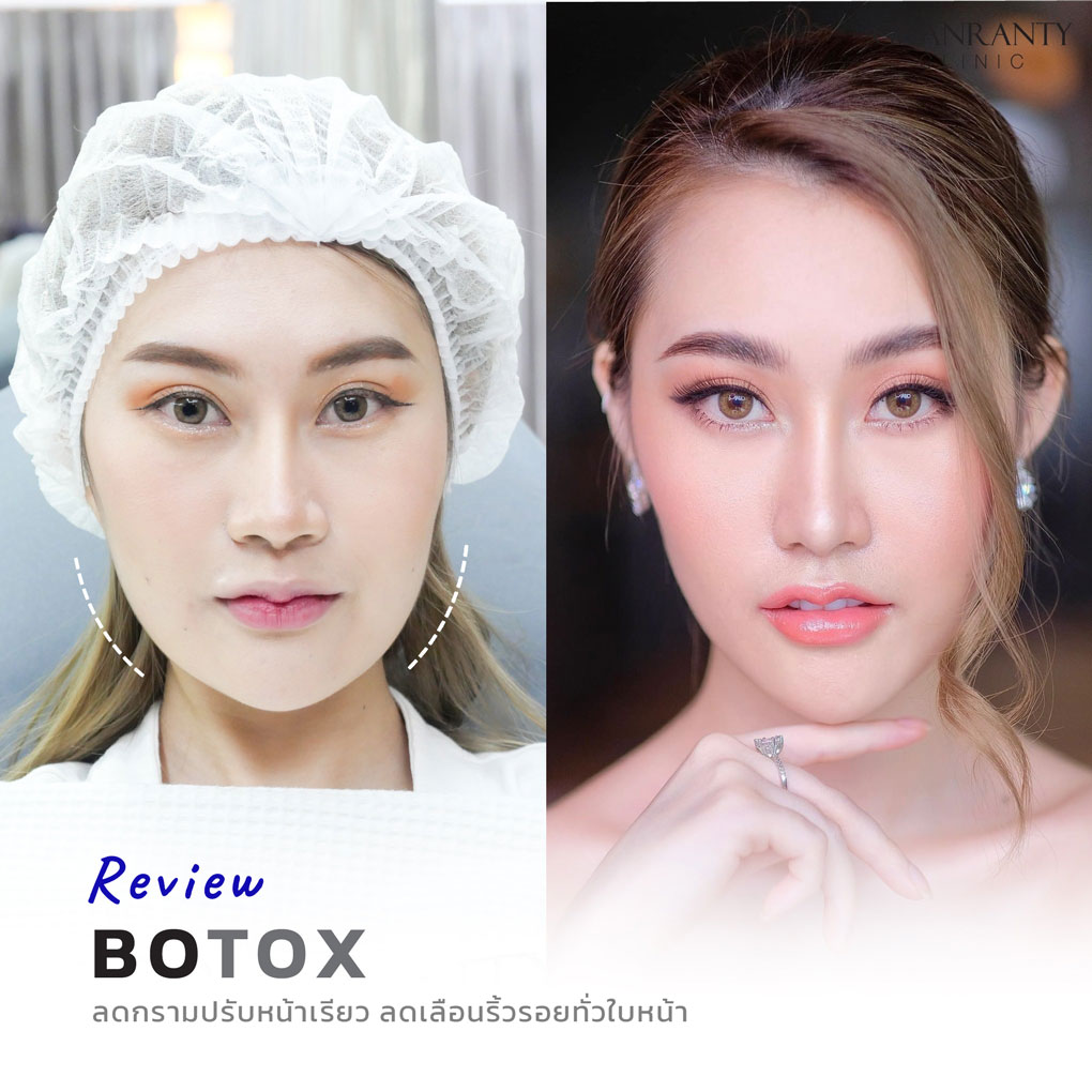 รีวิว BOTOX จีแรนตีคลินิก