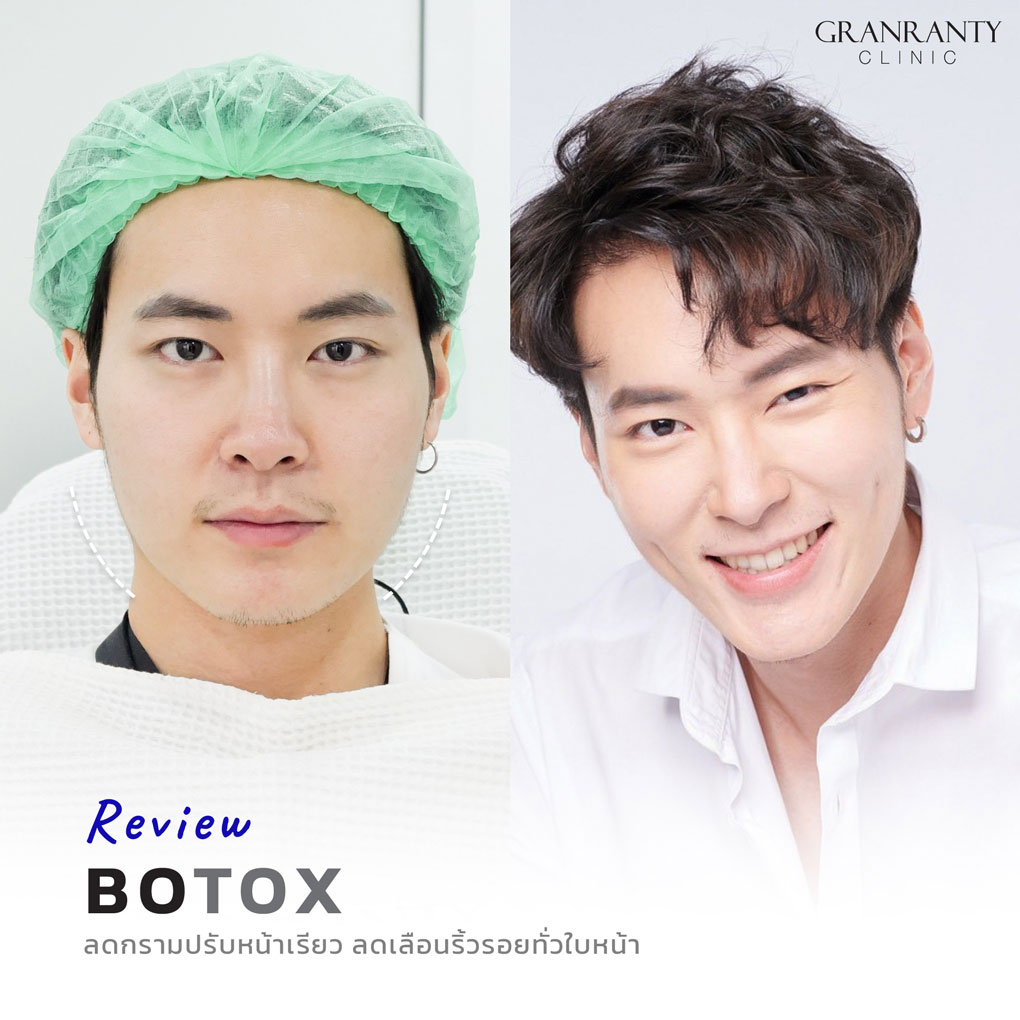 รีวิว BOTOX จีแรนตีคลินิก