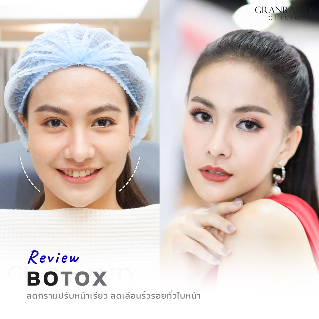 รีวิว BOTOX จีแรนตีคลินิก