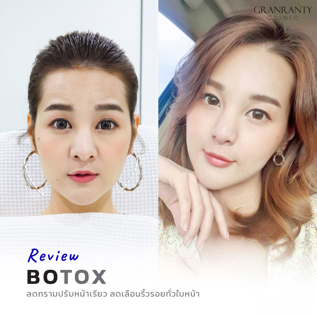 รีวิว BOTOX จีแรนตีคลินิก